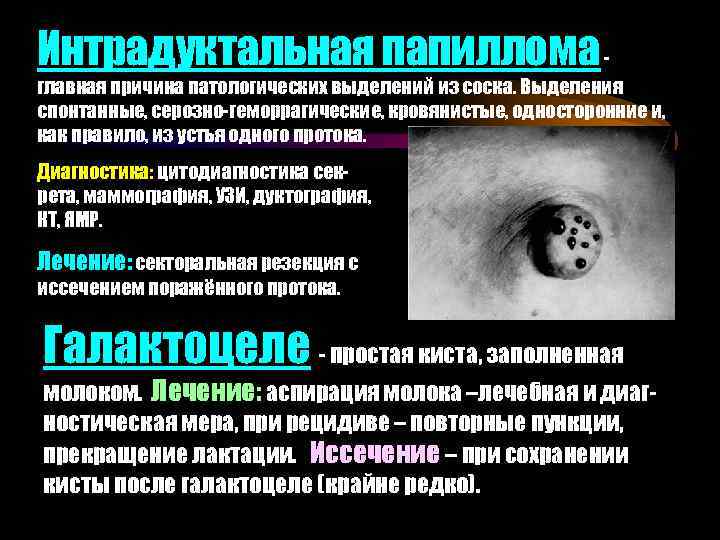 Интрадуктальная папиллома - главная причина патологических выделений из соска. Выделения спонтанные, серозно-геморрагические, кровянистые, односторонние