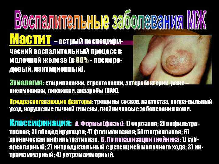 Мастит – острый неспецифический воспалительный процесс в молочной железе (в 90% - послеродовый, лактационный).