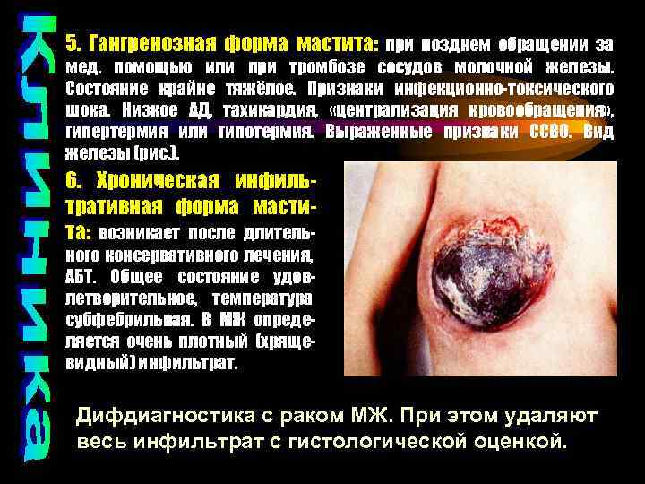 5. Гангренозная форма мастита: при позднем обращении за мед. помощью или при тромбозе сосудов