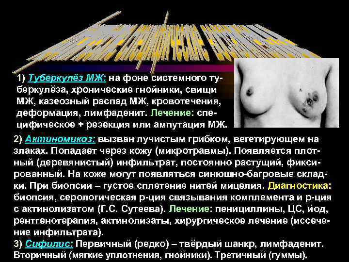 1) Туберкулёз МЖ: на фоне системного туберкулёза, хронические гнойники, свищи МЖ, казеозный распад МЖ,