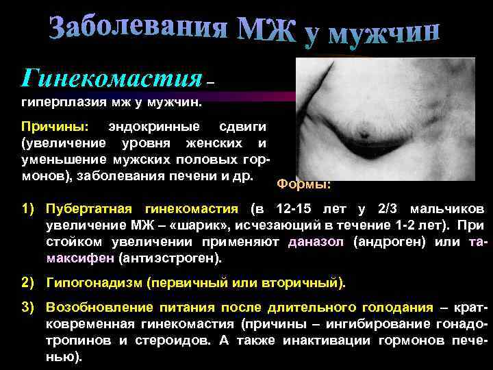 Гинекомастия – гиперплазия мж у мужчин. Причины: эндокринные сдвиги (увеличение уровня женских и уменьшение