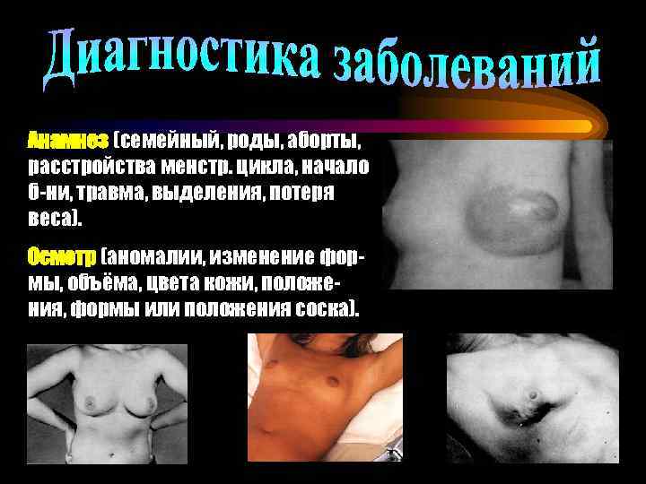 Анамнез (семейный, роды, аборты, расстройства менстр. цикла, начало б-ни, травма, выделения, потеря веса). Осмотр