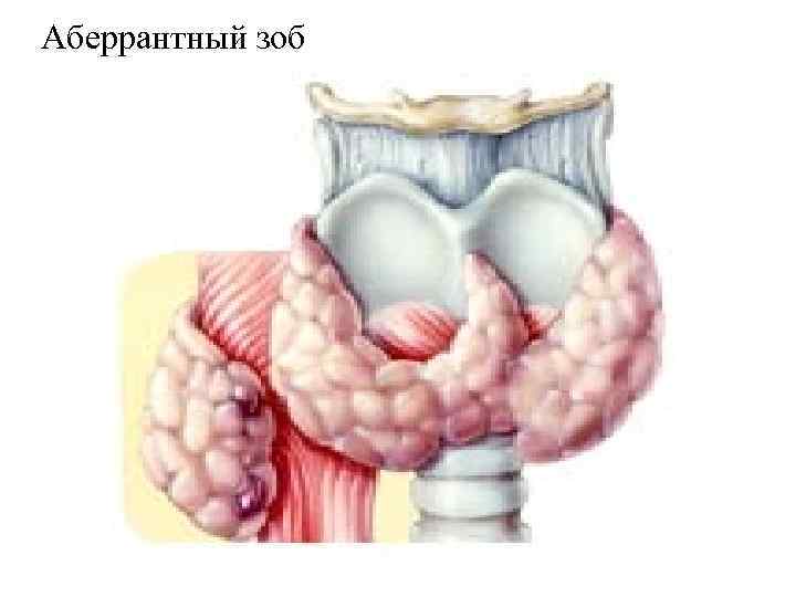 Аберрантный зоб 