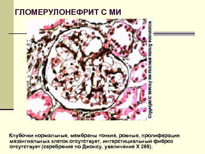 ГЛОМЕРУЛОНЕФРИТ С МИ Клубочки нормальные, мембраны тонкие, ровные, пролиферация мезангиальных клеток отсутствует, интерстициальный фиброз