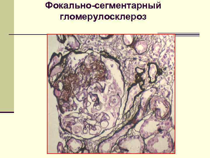 Фокально-сегментарный гломерулосклероз 