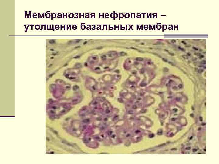 Мембранозная нефропатия – утолщение базальных мембран 
