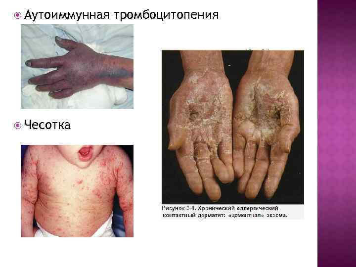  Аутоиммунная Чесотка тромбоцитопения 