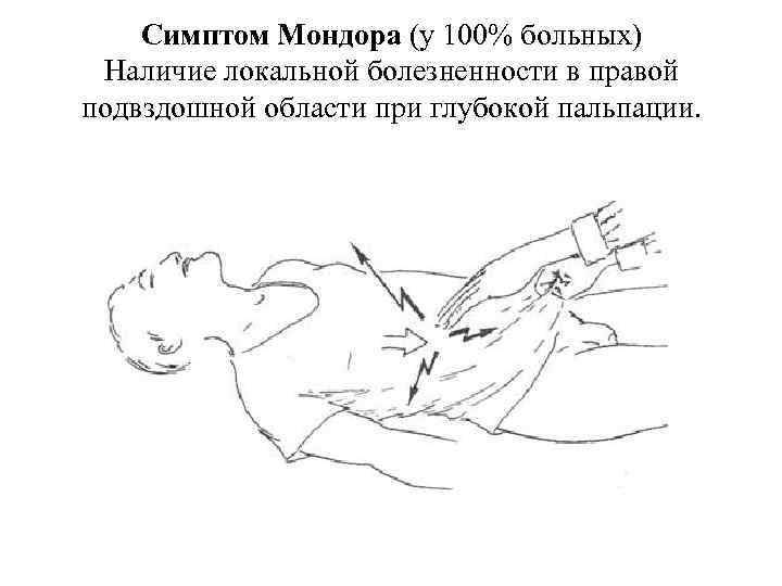 Симптом Мондора (у 100% больных) Наличие локальной болезненности в правой подвздошной области при глубокой