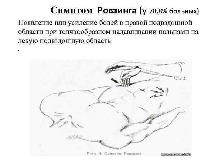 Особенности клинической картины острого аппендицита при тазовом расположении червеобразного отростка