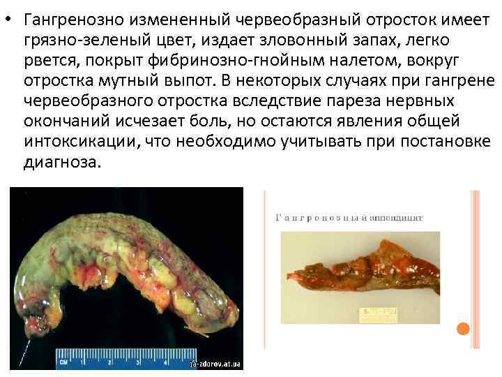  • Гангренозно измененный червеобразный отросток имеет грязно-зеленый цвет, издает зловонный запах, легко рвется,