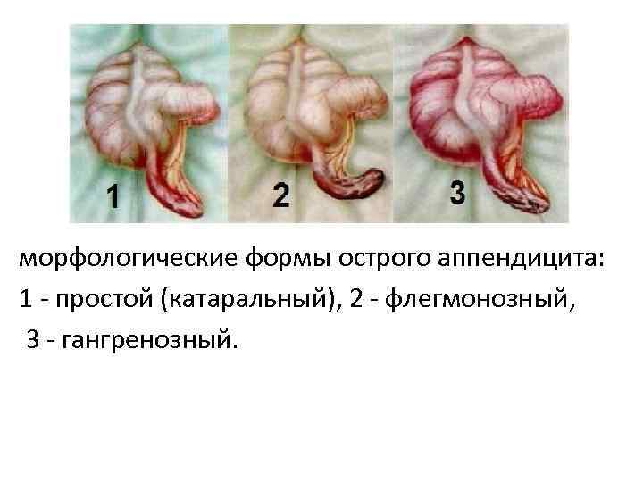 морфологические формы острого аппендицита: 1 - простой (катаральный), 2 - флегмонозный, 3 - гангренозный.