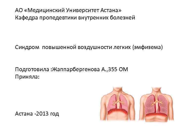 АО «Медицинский Университет Астана» Кафедра пропедевтики внутренних болезней Синдром повышенной воздушности легких (эмфизема) Подготовила