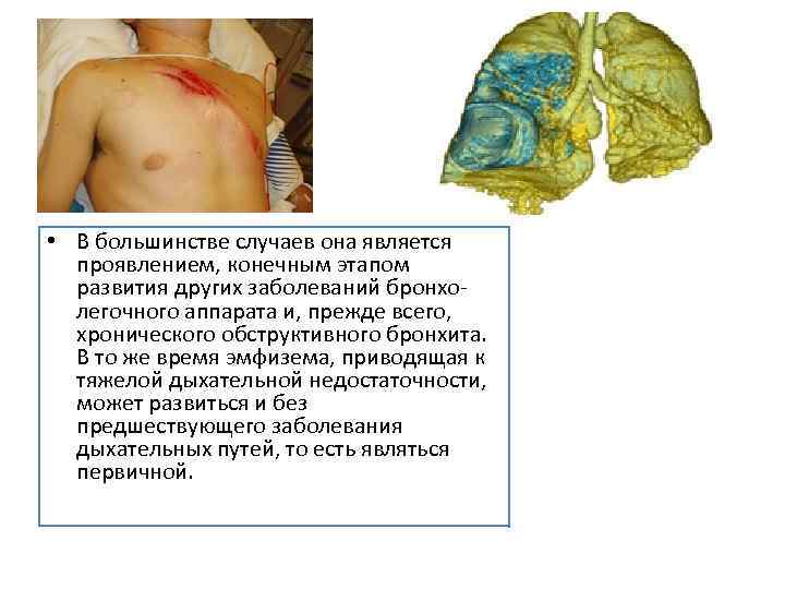  • В большинстве случаев она является проявлением, конечным этапом развития других заболеваний бронхолегочного