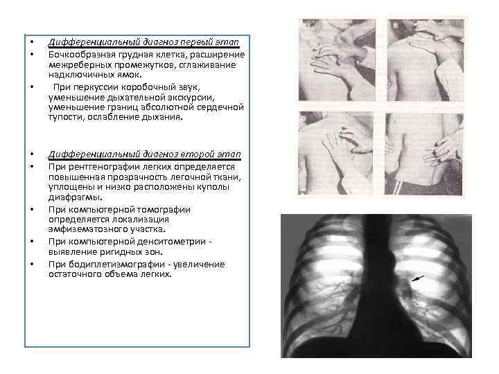  • • Дифференциальный диагноз первый этап Бочкообразная грудная клетка, расширение межреберных промежутков, сглаживание