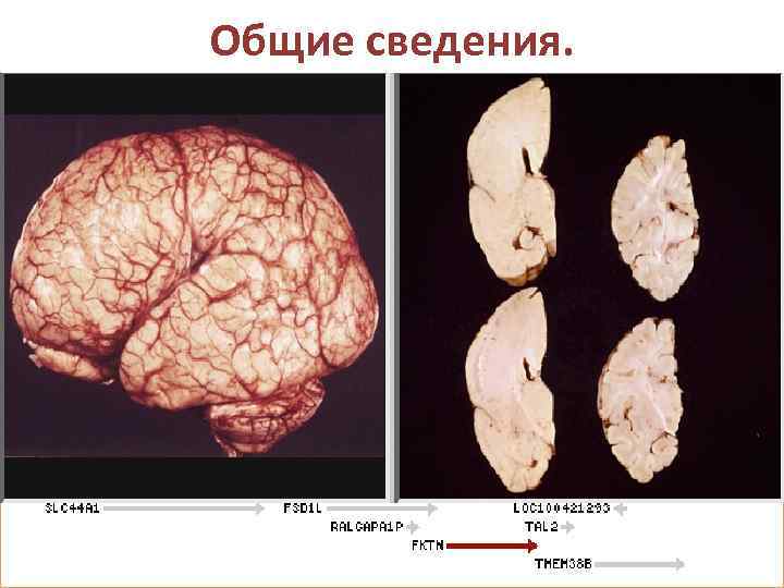 Общие сведения. Синдром Фукуямы - врождённая мышечная дистрофия, сопровождаемая лиссэнцефалией. Первые признаки возникают с