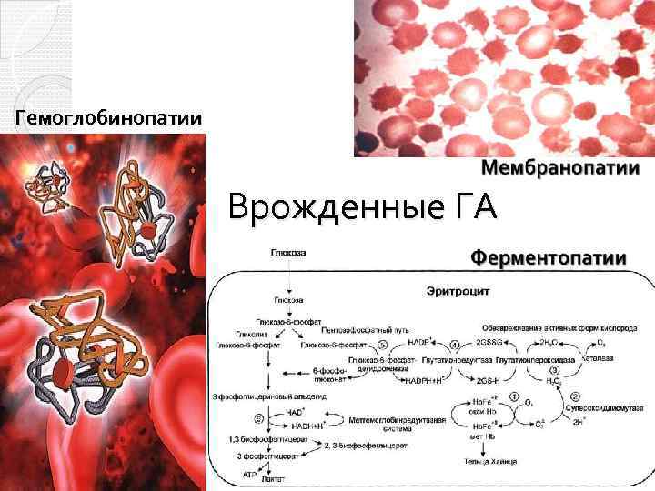 Врожденные гемолитические анемии