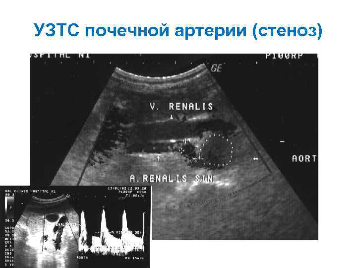 УЗТС почечной артерии (стеноз) 
