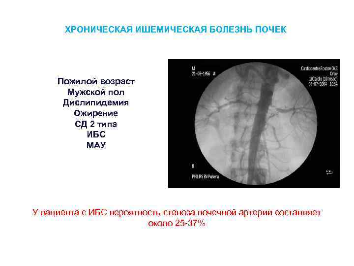 ХРОНИЧЕСКАЯ ИШЕМИЧЕСКАЯ БОЛЕЗНЬ ПОЧЕК Пожилой возраст Мужской пол Дислипидемия Ожирение СД 2 типа ИБС