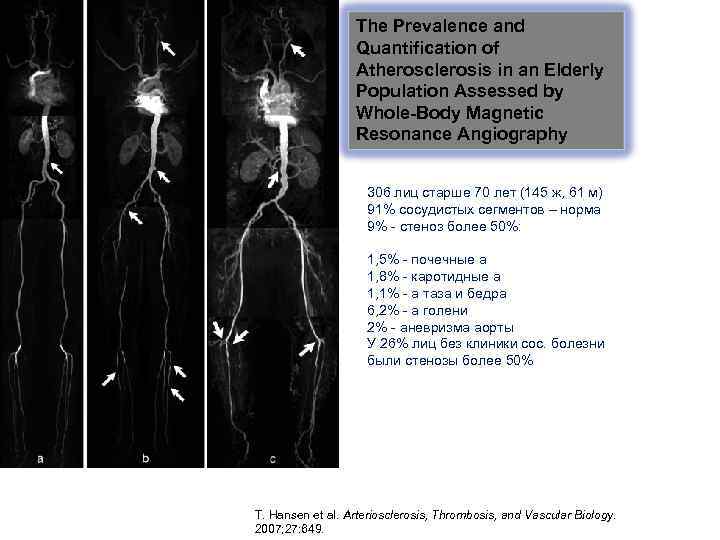 The Prevalence and Quantification of Atherosclerosis in an Elderly Population Assessed by Whole-Body Magnetic