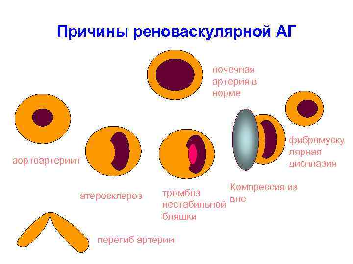 Причины реноваскулярной АГ почечная артерия в норме фибромуску лярная дисплазия аортоартериит атеросклероз Компрессия из