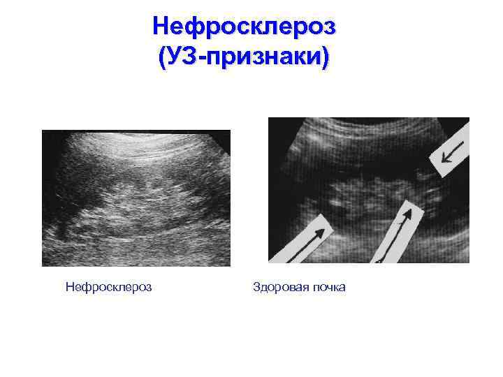 Нефросклероз (УЗ-признаки) Нефросклероз Здоровая почка 