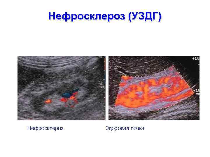Нефросклероз (УЗДГ) Нефросклероз Здоровая почка 