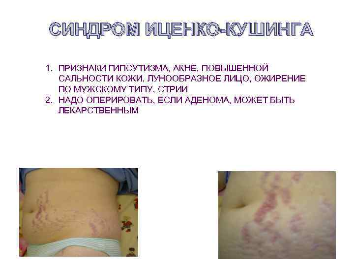 СИНДРОМ ИЦЕНКО-КУШИНГА 1. ПРИЗНАКИ ГИПСУТИЗМА, АКНЕ, ПОВЫШЕННОЙ САЛЬНОСТИ КОЖИ, ЛУНООБРАЗНОЕ ЛИЦО, ОЖИРЕНИЕ ПО МУЖСКОМУ