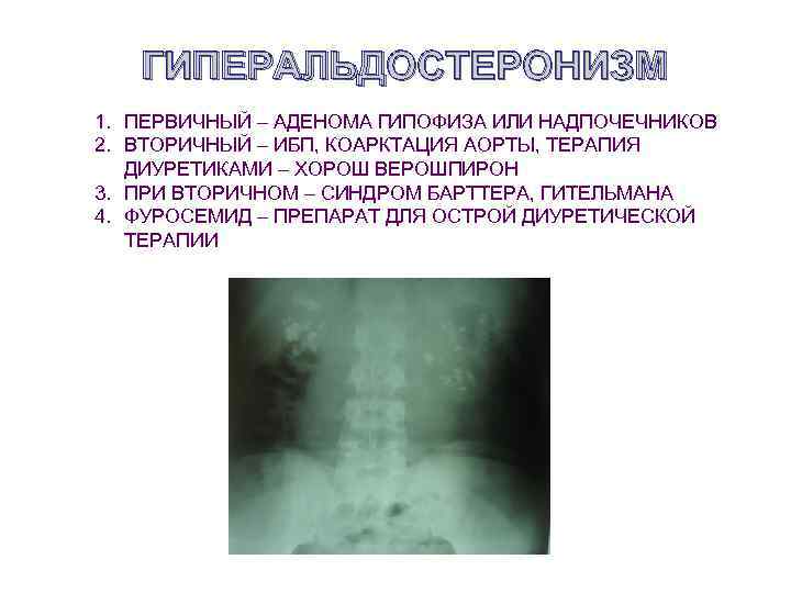 ГИПЕРАЛЬДОСТЕРОНИЗМ 1. ПЕРВИЧНЫЙ – АДЕНОМА ГИПОФИЗА ИЛИ НАДПОЧЕЧНИКОВ 2. ВТОРИЧНЫЙ – ИБП, КОАРКТАЦИЯ АОРТЫ,