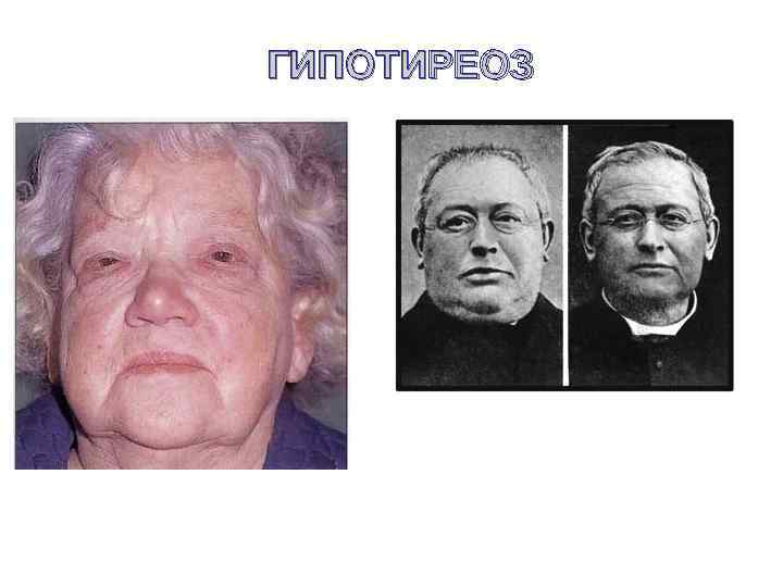 ГИПОТИРЕОЗ 