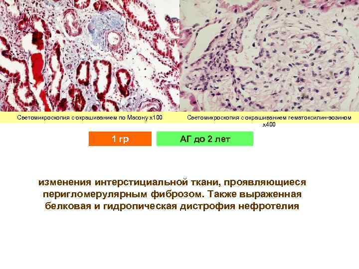 Светомикроскопия с окрашиванием по Масону х100 1 гр Светомикроскопия с окрашиванием гематоксилин-эозином х400 АГ