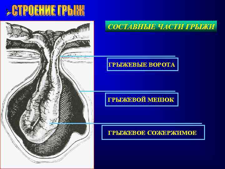 СОСТАВНЫЕ ЧАСТИ ГРЫЖЕВЫЕ ВОРОТА ГРЫЖЕВОЙ МЕШОК ГРЫЖЕВОЕ СОЖЕРЖИМОЕ 