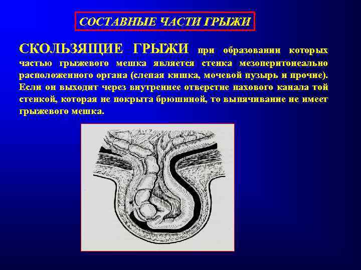 СОСТАВНЫЕ ЧАСТИ ГРЫЖИ СКОЛЬЗЯЩИЕ ГРЫЖИ при образовании которых частью грыжевого мешка является стенка мезоперитонеально