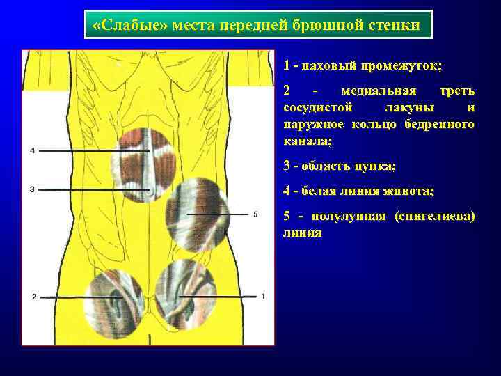  «Слабые» места передней брюшной стенки 1 - паховый промежуток; 2 медиальная треть сосудистой