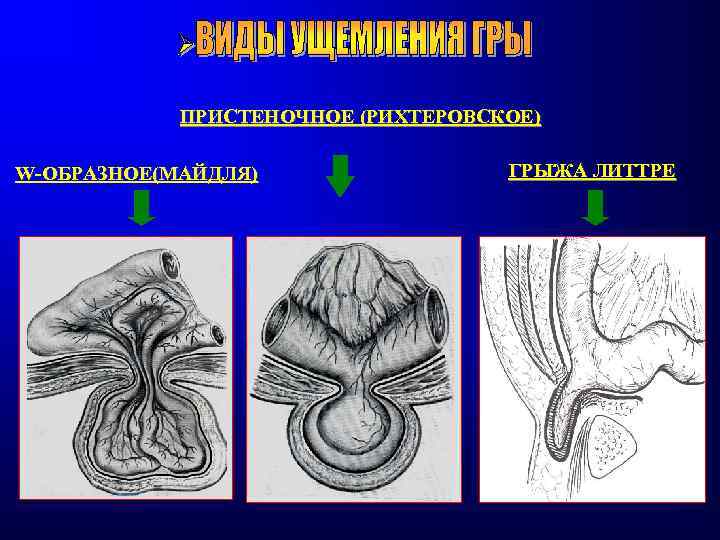 ПРИСТЕНОЧНОЕ (РИХТЕРОВСКОЕ) W-ОБРАЗНОЕ(МАЙДЛЯ) ГРЫЖА ЛИТТРЕ 