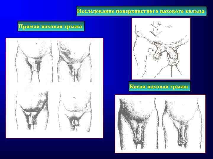 Исследование поверхностного пахового кольца Прямая паховая грыжа Косая паховая грыжа 