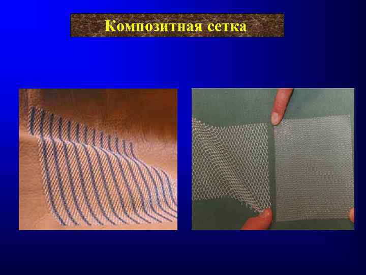 Композитная сетка 