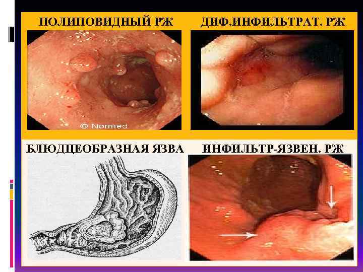 ПОЛИПОВИДНЫЙ РЖ ДИФ. ИНФИЛЬТРАТ. РЖ БЛЮДЦЕОБРАЗНАЯ ЯЗВА ИНФИЛЬТР-ЯЗВЕН. РЖ 