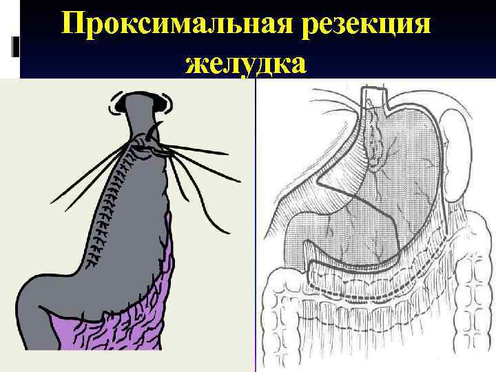 Проксимальная резекция желудка 
