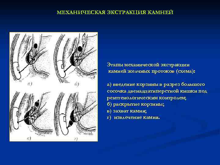 МЕХАНИЧЕСКАЯ ЭКСТРАКЦИЯ КАМНЕЙ Этапы механической экстракции камней желчных протоков (схема): а) введение корзины в