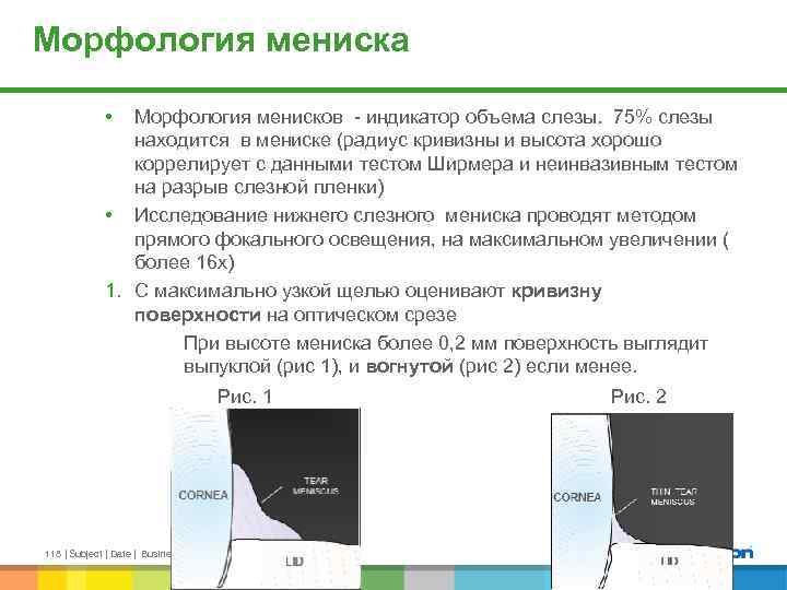 Морфология мениска • Морфология менисков - индикатор объема слезы. 75% слезы находится в мениске