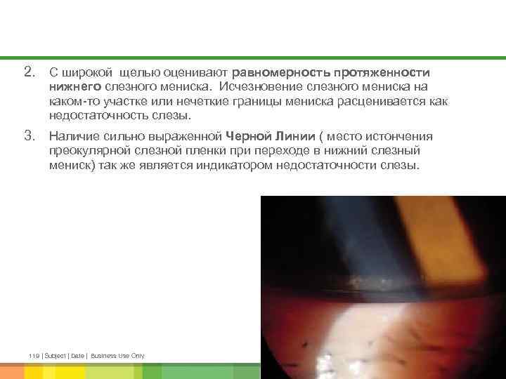 2. С широкой щелью оценивают равномерность протяженности нижнего слезного мениска. Исчезновение слезного мениска на