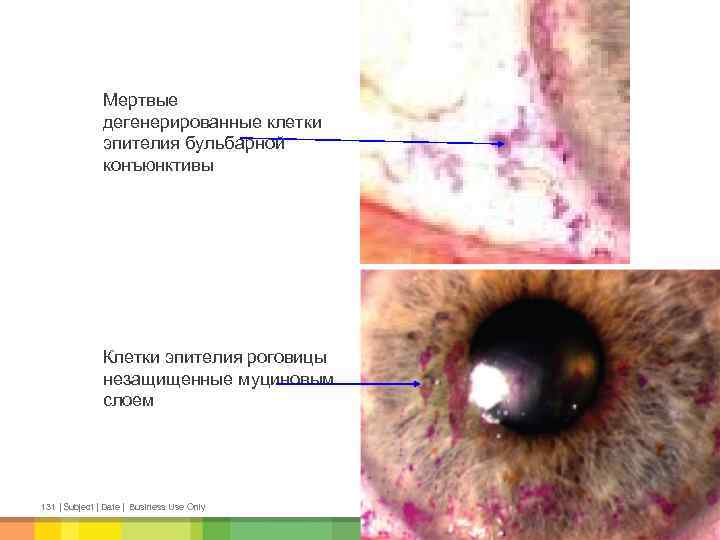 Мертвые дегенерированные клетки эпителия бульбарной конъюнктивы Клетки эпителия роговицы незащищенные муциновым слоем 131 |