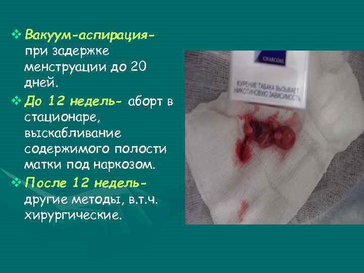 v Вакуум-аспирацияпри задержке менструации до 20 дней. v До 12 недель- аборт в стационаре,