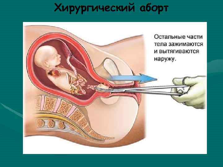 Прерывание беременности картинки