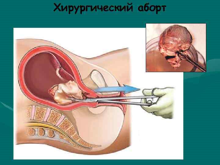 Хирургический аборт 