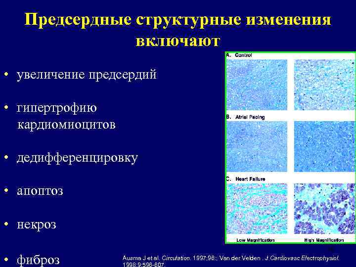 Предсердные структурные изменения включают • увеличение предсердий • гипертрофию кардиомиоцитов • дедифференцировку • апоптоз