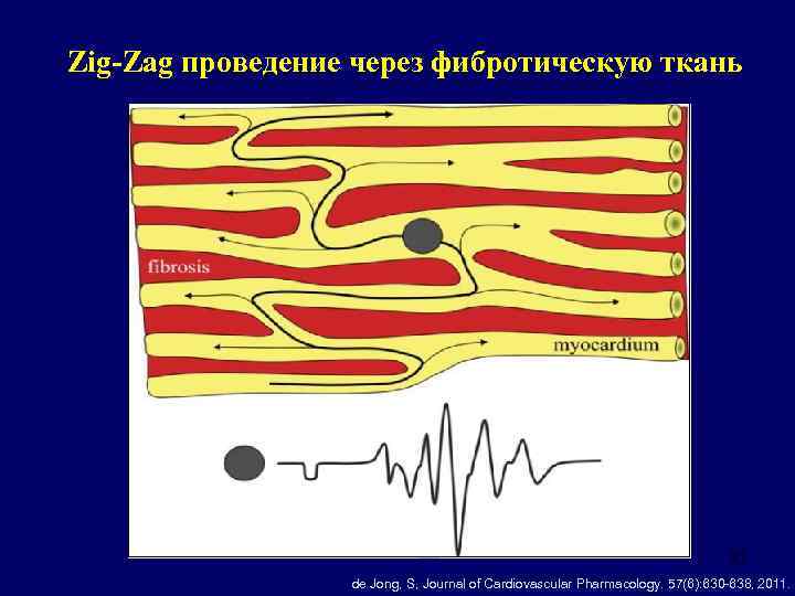 Zig-Zag проведение через фибротическую ткань 21 de Jong, S, Journal of Cardiovascular Pharmacology. 57(6):