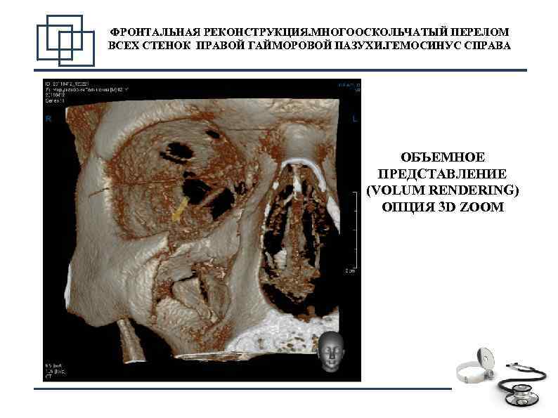ФРОНТАЛЬНАЯ РЕКОНСТРУКЦИЯ. МНОГООСКОЛЬЧАТЫЙ ПЕРЕЛОМ ВСЕХ СТЕНОК ПРАВОЙ ГАЙМОРОВОЙ ПАЗУХИ. ГЕМОСИНУС СПРАВА ОБЪЕМНОЕ ПРЕДСТАВЛЕНИЕ (VOLUM