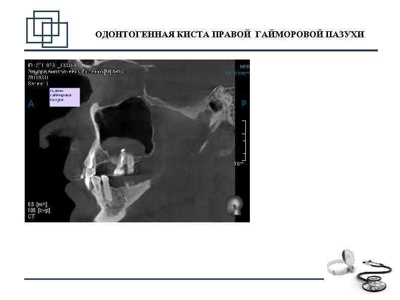 ОДОНТОГЕННАЯ КИСТА ПРАВОЙ ГАЙМОРОВОЙ ПАЗУХИ 11 