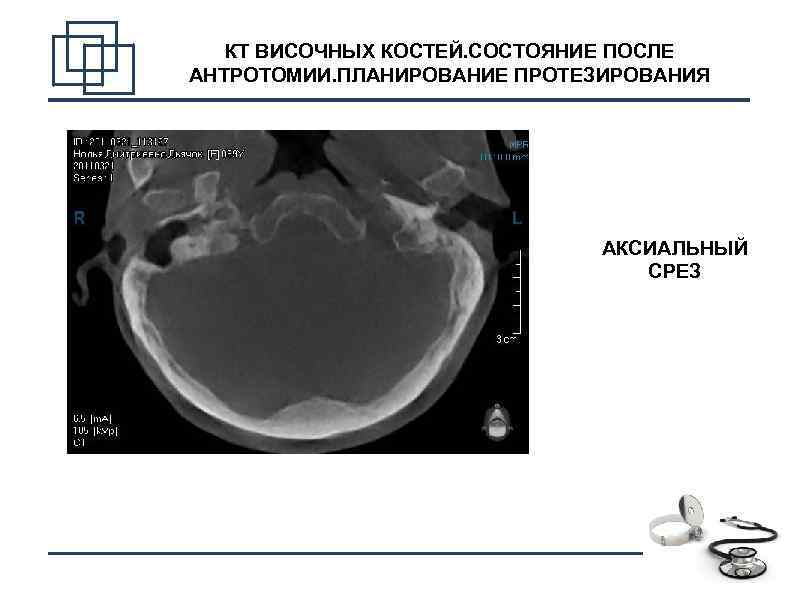 КТ ВИСОЧНЫХ КОСТЕЙ. СОСТОЯНИЕ ПОСЛЕ АНТРОТОМИИ. ПЛАНИРОВАНИЕ ПРОТЕЗИРОВАНИЯ АКСИАЛЬНЫЙ СРЕЗ 12 